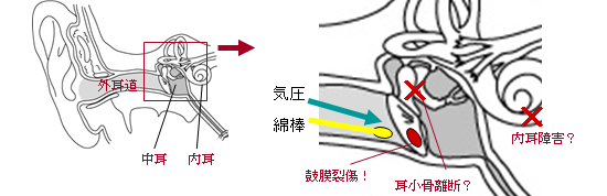 見せる耳鼻科治療 耳鼻咽喉科かめやまクリニック 山口市 山口県 鼓膜外傷 症例