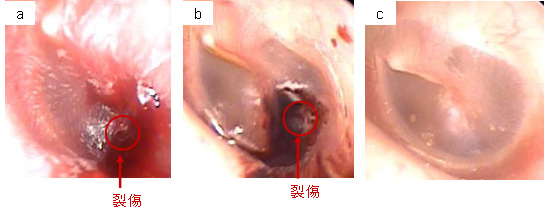 見せる耳鼻科治療 耳鼻咽喉科かめやまクリニック 山口市 山口県 鼓膜外傷 症例