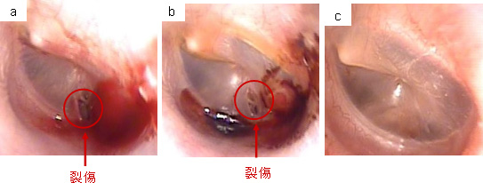 見せる耳鼻科治療 耳鼻咽喉科かめやまクリニック 山口市 山口県 鼓膜外傷 症例
