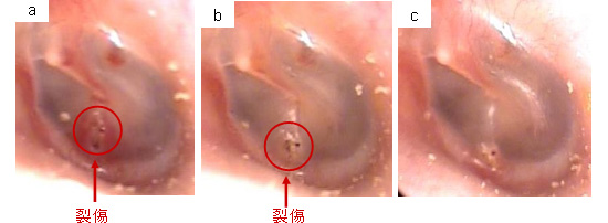 見せる耳鼻科治療 耳鼻咽喉科かめやまクリニック 山口市 山口県 鼓膜外傷 症例