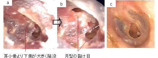 見せる耳鼻科治療 耳鼻咽喉科かめやまクリニック 山口市 山口県 鼓膜外傷 症例