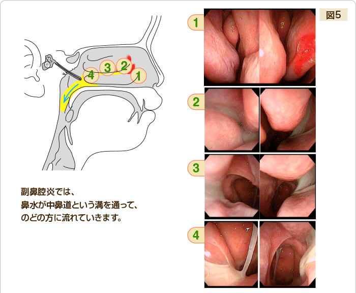 鼻 の 奥 が 詰まる